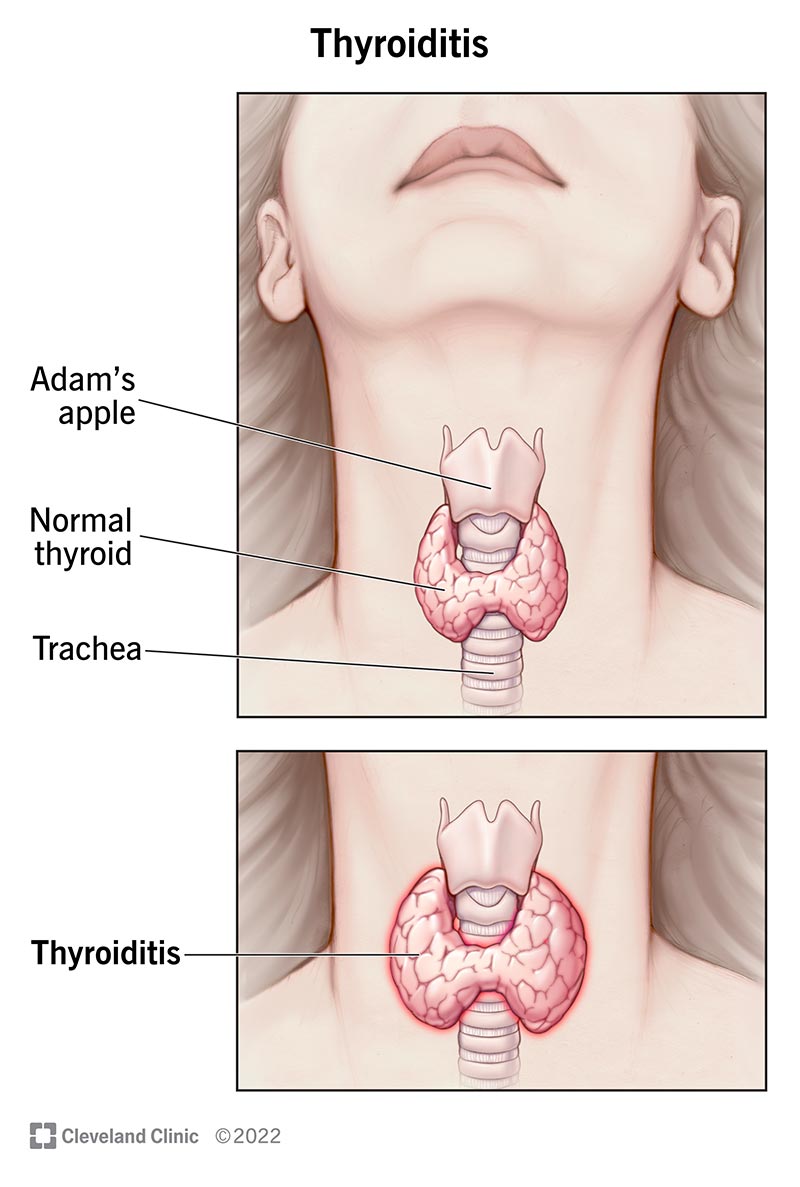 Swollen Thyroid Gland: Autoimmune Diseases & Other Key Causes